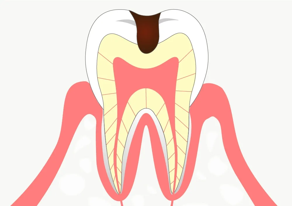 歯の表面の虫歯