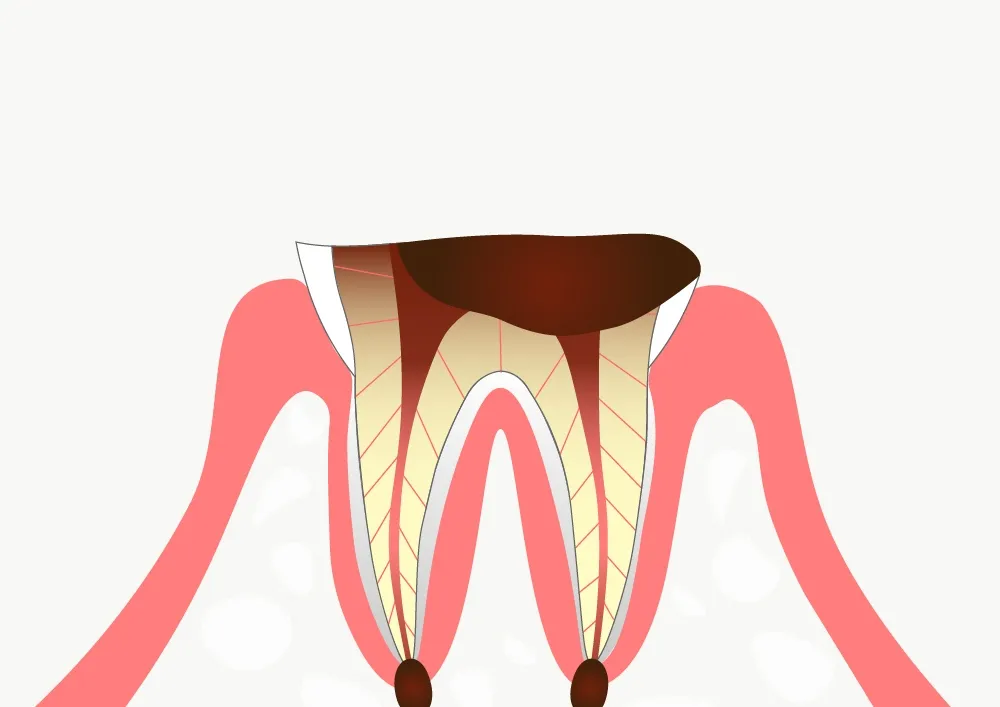 歯の根まで達した虫歯