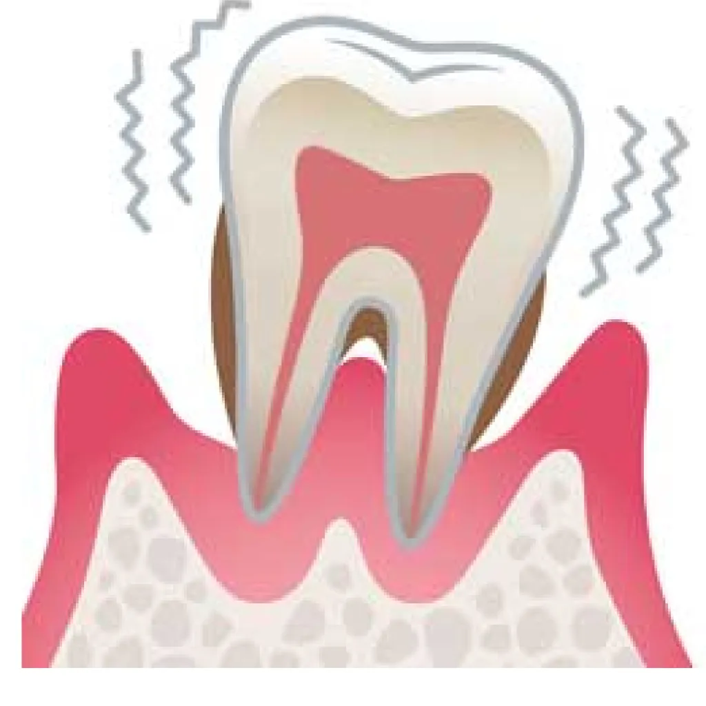 歯がグラグラする